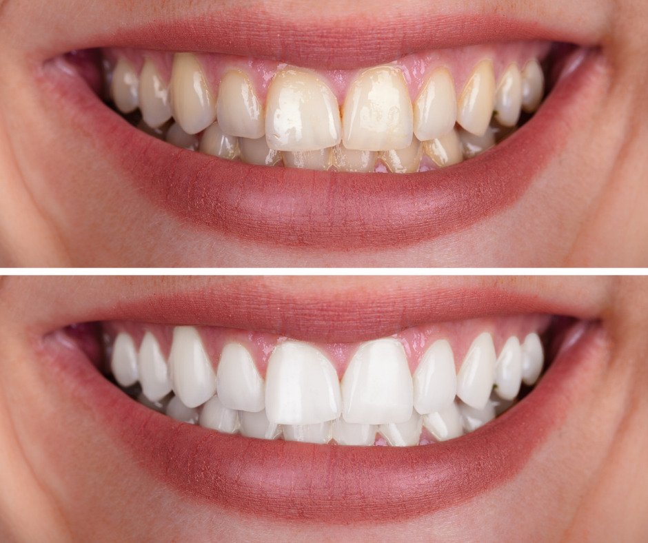 Teeth scaling/whitening