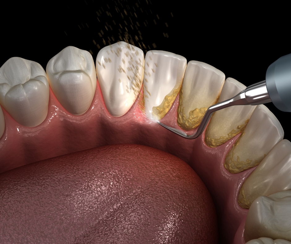 Teeth scaling and whitening